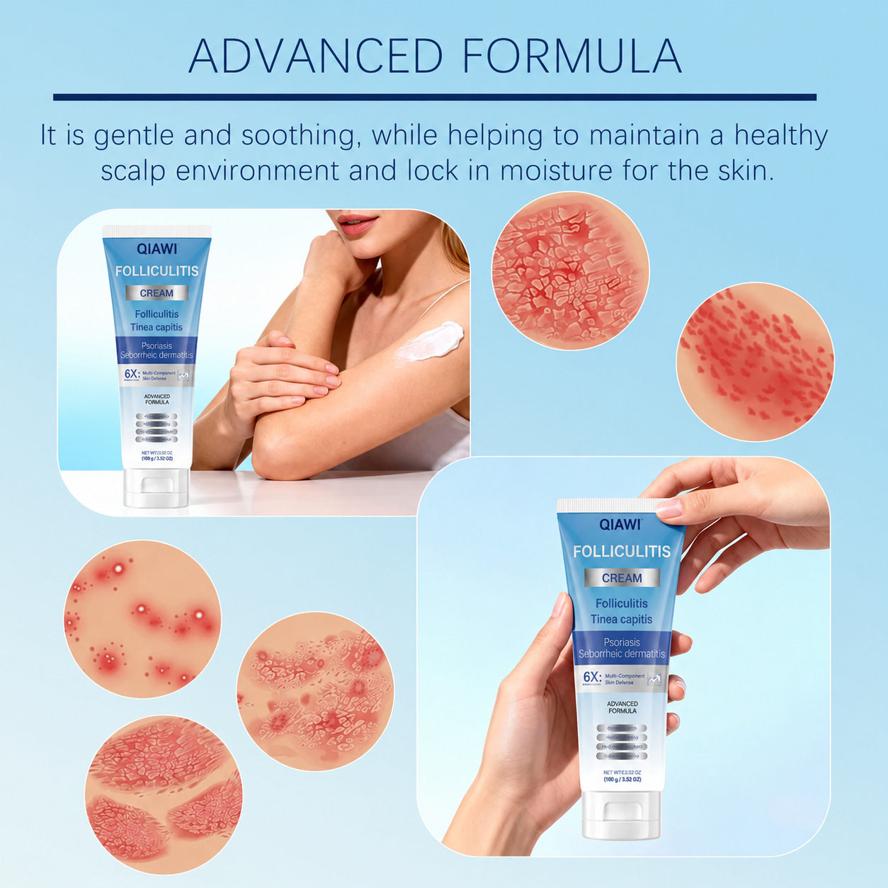 Folliculitis Soothing Cream for Folliculitis Scalp Face and Body✨
