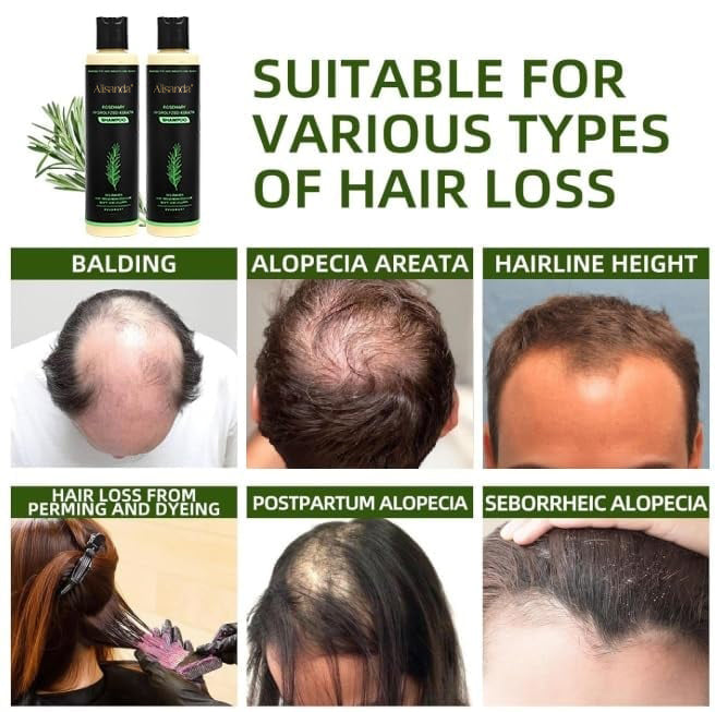 Buy 1 Get 1 FREE 🎁-Rosemary Shampoo | Hair Growth & Anti-Dandruff Scalp Treatment